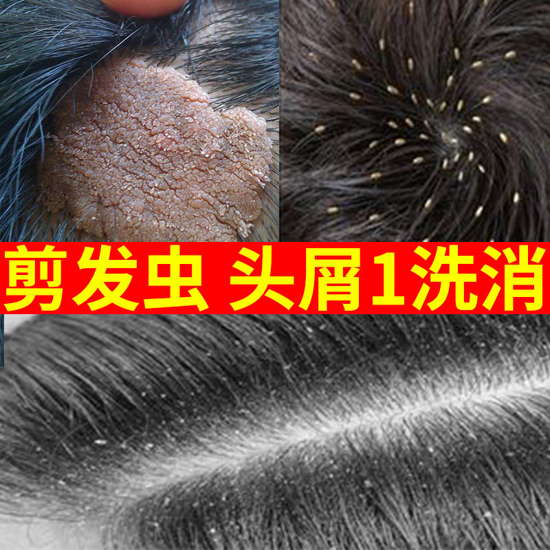 剪发虫洗发水卷发去头上长头皮屑除去屑痒药严重止痒中药专用儿童