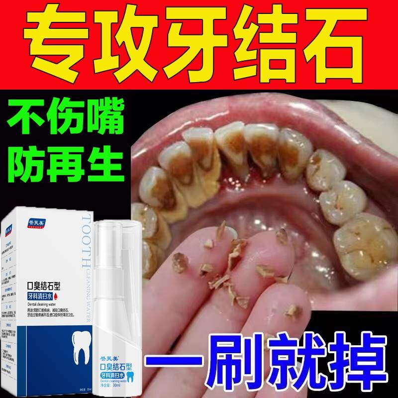 洗牙齿污垢除牙石的专用药水牙结石去除器溶解牙石牙垢黄牙速效喷