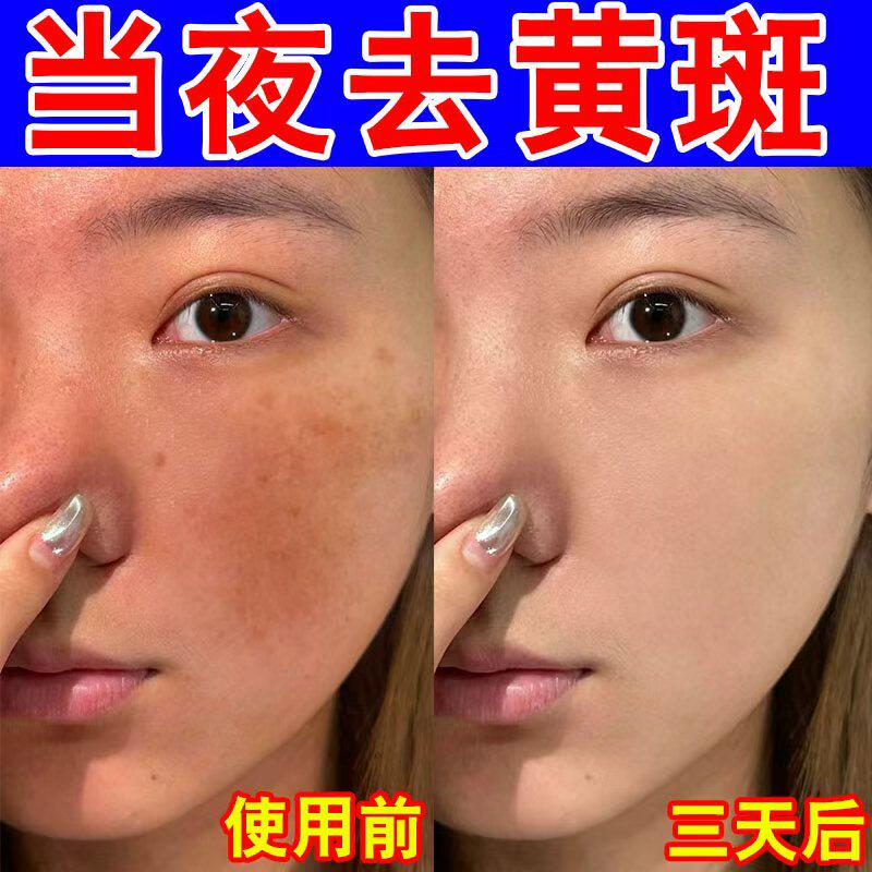 祛斑专用黄褐斑老年斑黑斑美白精乳液/面霜