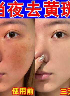 祛斑专用黄褐斑老年斑黑斑美白精华液分解黑色素一擦就掉祛斑神器