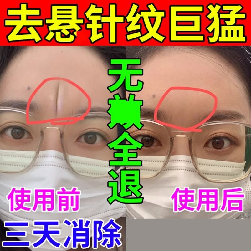 悬针纹去除抬头额头川八字鱼尾纹男提拉紧致皱涂抹式填充物理消贴