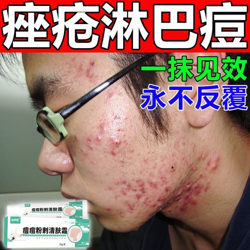 痤疮特效药淋巴痘腮边痘下巴痤疮膏重度暗疮去豆疤印消印祛痘男生