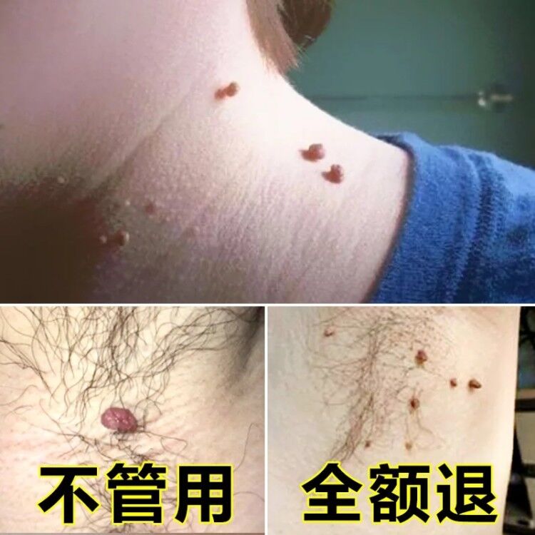 扁平丝状疣面部去除药膏去疣膏去除手足部日本病毒寻常疣刺瘊子