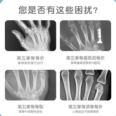 掌。骨骨折手指指套第四第五手掌小拇指支具固定器手腕夹板固定g 运动/瑜伽/健身/球迷用品 运动护腕 原图主图