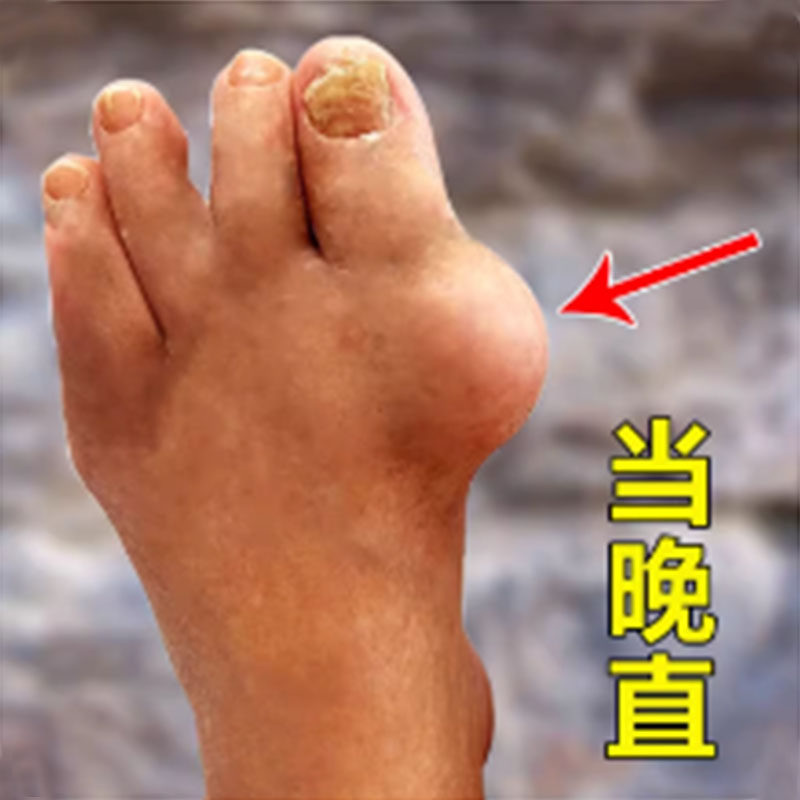 拇指外翻贴大脚骨突出变形矫正器脚趾重叠严重拇外翻专用膏药xa