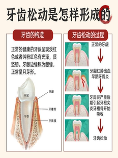 牙松动牙萎缩牙龈肿痛牙晃动牙酸痛牙周炎专用牙膏MH 固齿强根