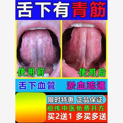 舌下青筋又黑又粗舌头底血管严重怒张血管突起舌淤血疏通专用喷剂