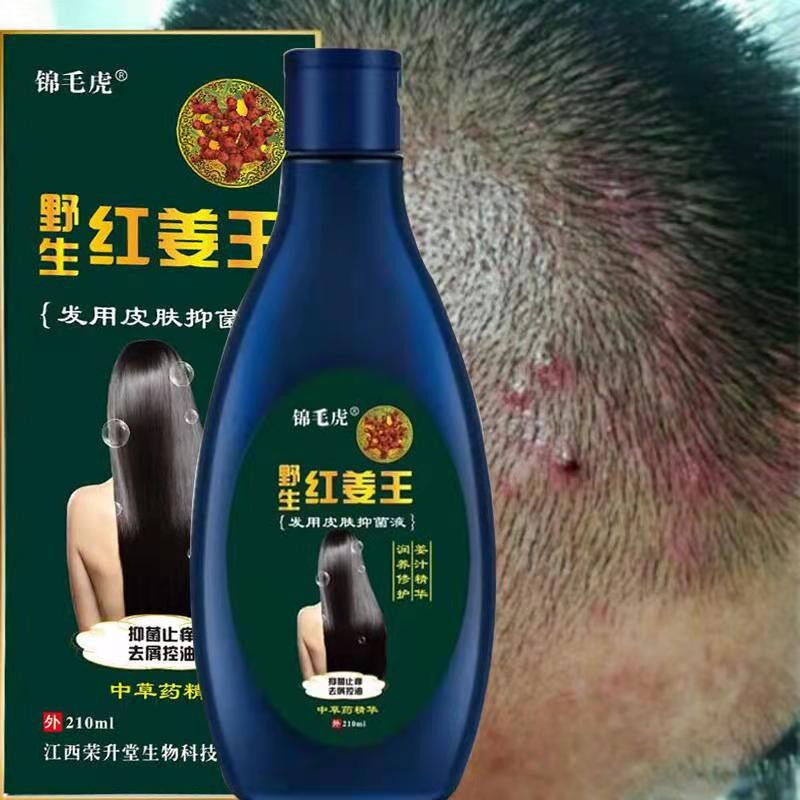 头上长红疙瘩头皮长痘痘痒头皮屑多去头屑洗发水治毛囊发专炎用药