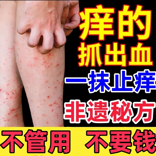 止特痒效皮肤瘙痒湿外用去苗疹家湿毒膏进口正品专用抑菌乳膏根