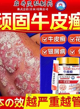日本特效牛皮癣膏！无效包退！！