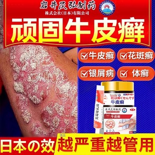 牛皮癣专用药膏银屑病治疗顽固特效药体股藓皮肤病止痒抑菌湿疹手足体股头皮苗草非药专杀菌止痒用正特品效膏