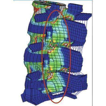 代做 医学有限元 ABAQUS mimics 模型 关节 牙齿 腰椎 支架