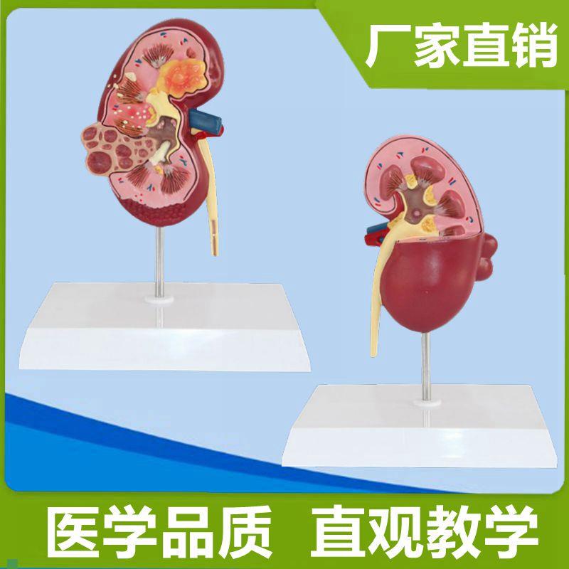 病理肾脏临床常见医患泌尿系统内脏医药礼品科普展示健Z康宣传人