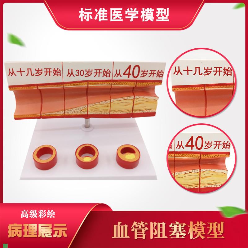人体血管模型动脉l血管阻塞变化演示教学模型器官解剖结构层次模