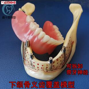 牙科口腔下颌骨展示模型 透明下o颌骨展示种植钉 义齿修复模型600