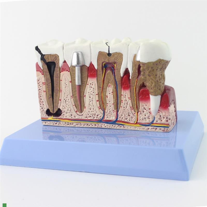 ENOVO颐诺牙齿模型口腔牙齿科种植模型口腔病理模型W口腔医院医患