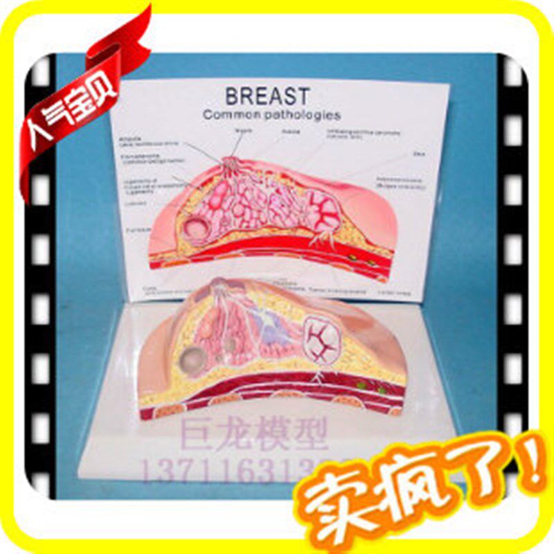 医学 乳房常见疾病模型 乳房病理B解剖结构模型 乳房模型 妇科模
