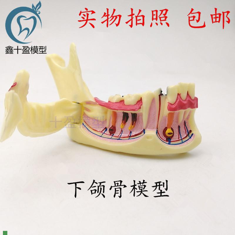 牙科下颌骨组织j分解模型半侧可打开根部龋坏牙齿分解模型4014