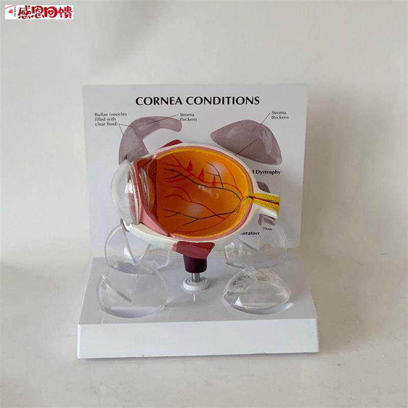 角膜模型眼睛结构白内障青光D眼晶状体视力模糊眼科教学视网膜眼