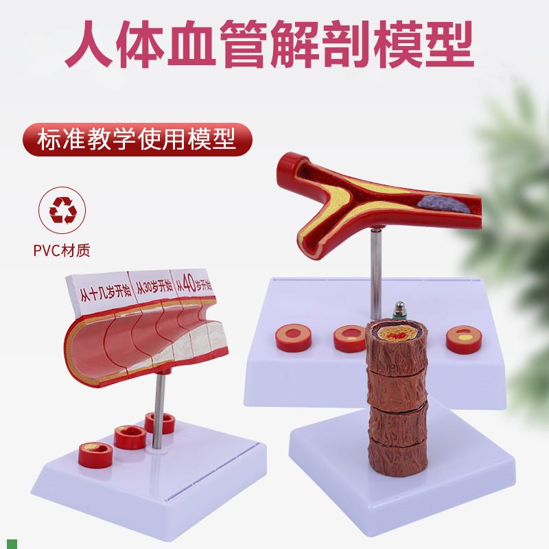 人体血管模型粥样动脉/硬化模型病变血栓/血管S/病演示血管模型