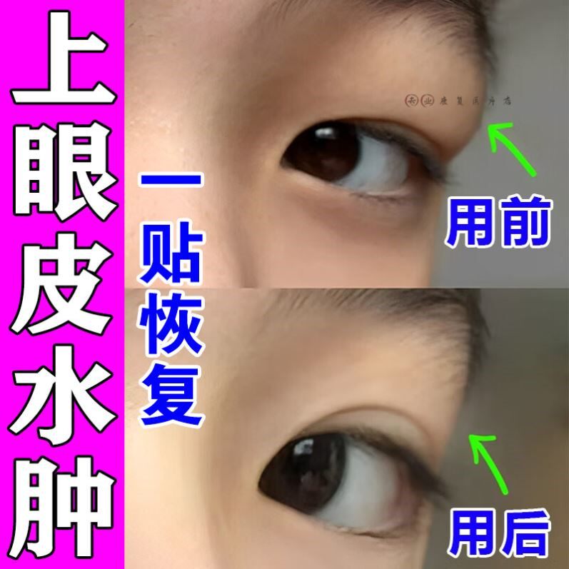 肿眼泡鱼泡眼眼皮肿去消祛浮肿神器眼睛熬夜红肿发红干涩专用眼贴