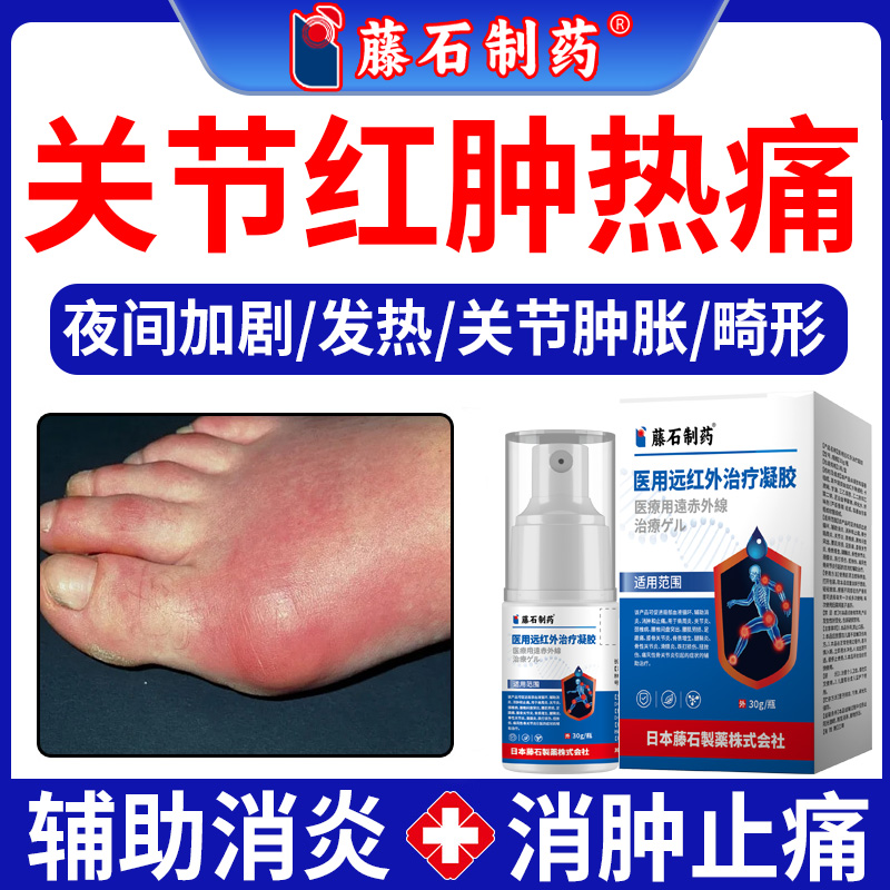 男性痛风关节炎剧烈疼痛