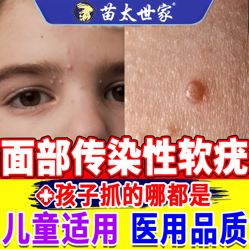 传染性软疣儿童病毒性水猴子软膏祛疣瘊扁平疣面部小肉粒镊子qo