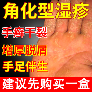 手指角化型湿疹皲裂性湿疹手癣膏手癣膏增厚脱皮干裂真菌感染