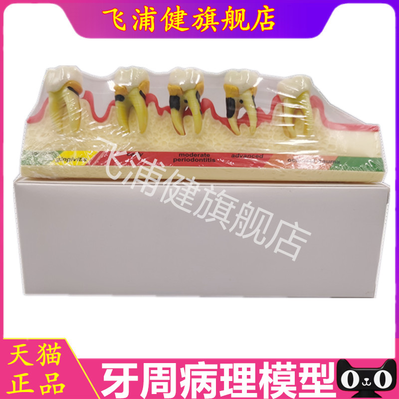 牙科口腔教学模型 牙周病理模型 练习刮治结石 牙周分类医患沟通