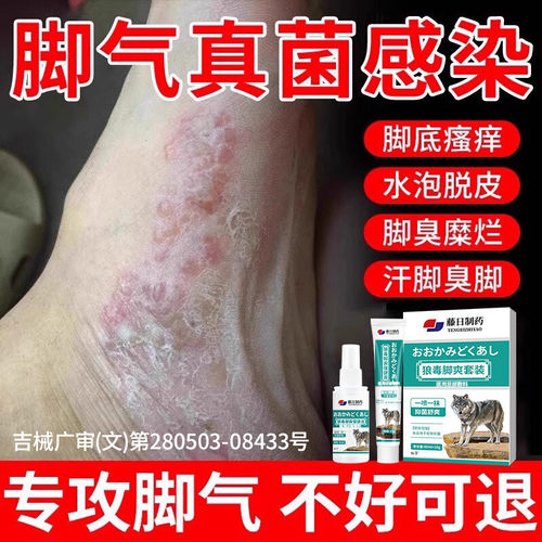 【脚气药喷雾】止脱皮痒杀菌