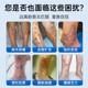 脉管炎老烂腿专用静脉曲张烂脚溃烂伤口愈合非祛去腐生肌膏大药房