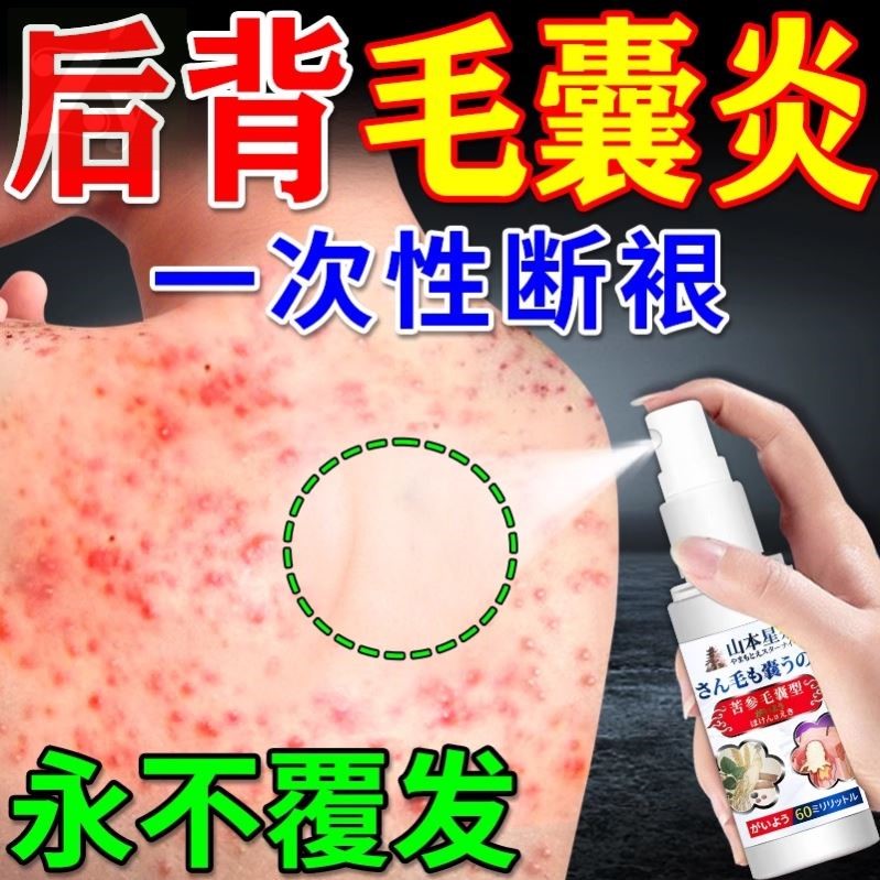 毛囊炎喷雾剂后背上长痘痘毛囊炎除螨祛痘痒马拉色真细菌特喷药效