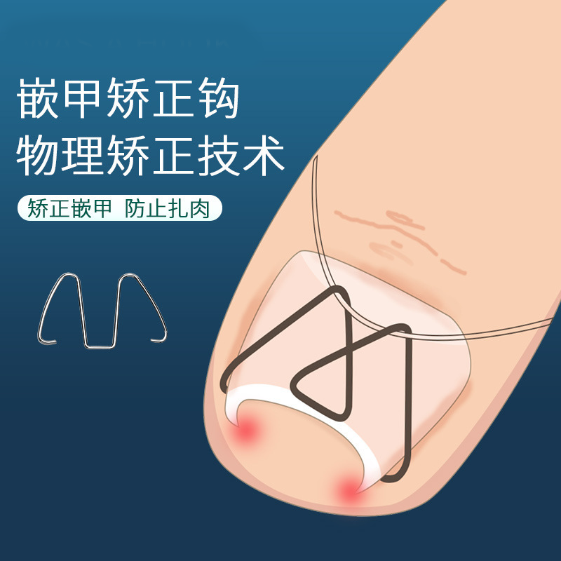 正甲丝指甲往肉里长甲沟纠正勾炎嵌甲矫正丝脚趾甲矫正器修脚工具