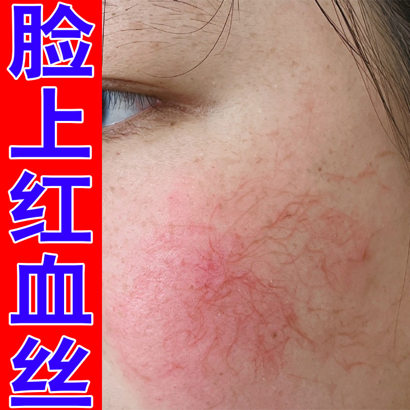 脸颊敏感泛红脸上长红血丝皮肤发痒干燥外用草本软膏脸上血丝严重