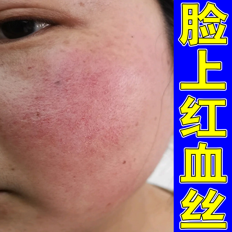 冶脸上长红血丝皮肤泛红发痒专用草本软膏脸上红血丝脸颊敏感红痒