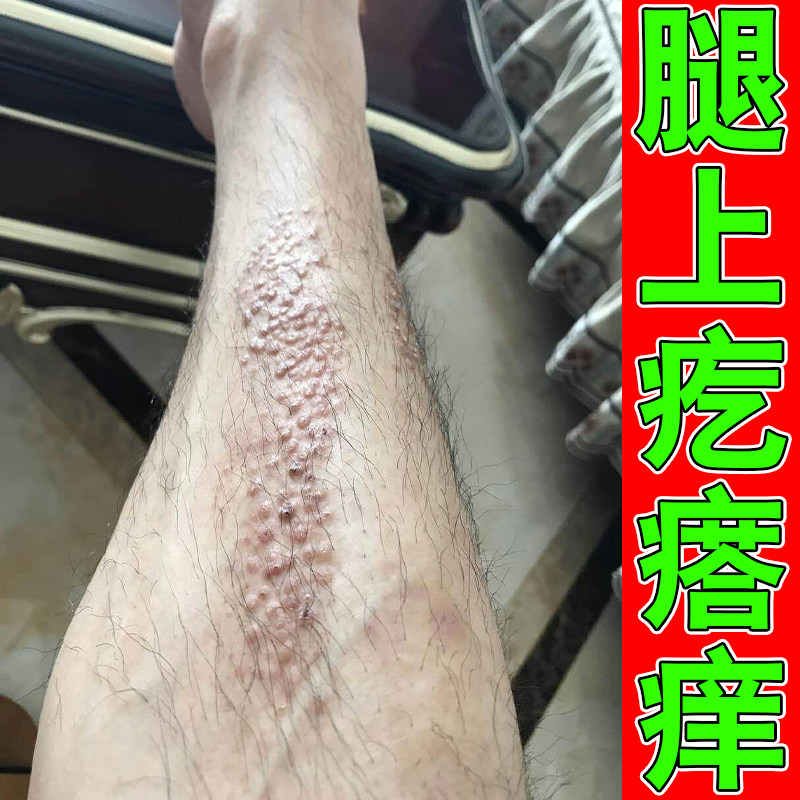 小腿长疙瘩小颗粒皮肤发痒感染草本软膏腿上疙瘩干淀燥粉粗样糙变