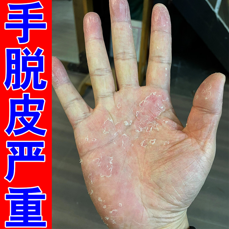 手干燥脱皮严重换季皮肤干燥粗糙感染外用草本保湿软膏手掌起皮