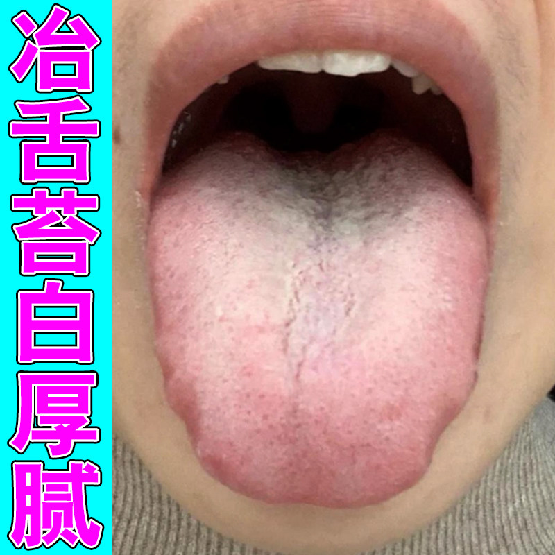 舌苔白厚口干口苦舌苔发黄厚调理皮肤消毒护理（消）
