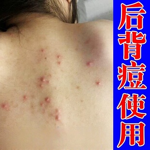 后背痘去毛囊皮肤修复药除前胸后背痘印真菌换季过敏干燥痒外用膏