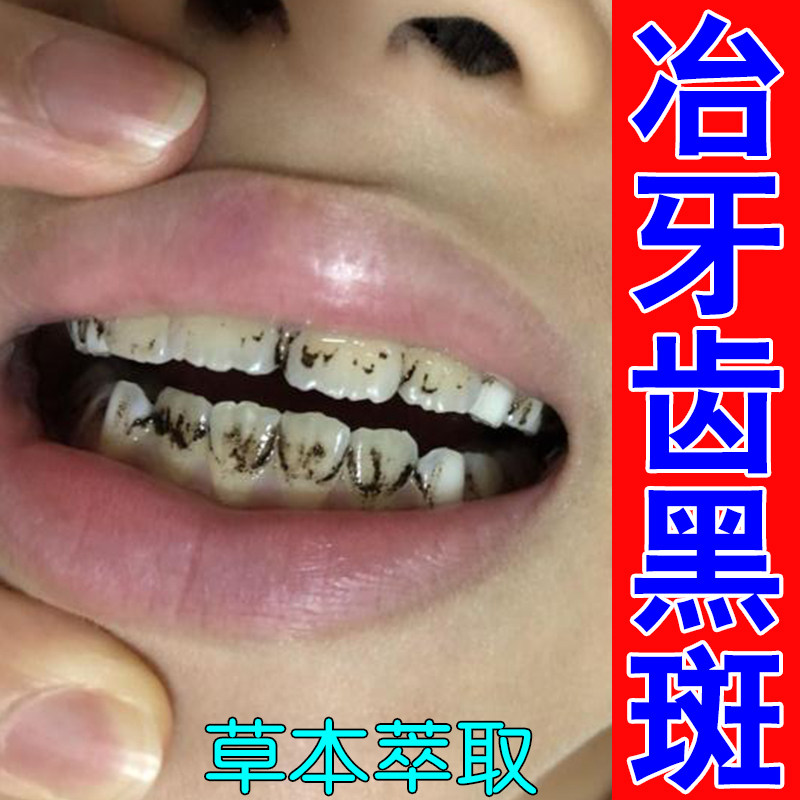 冶牙齿长黑斑牙菌斑牙根有黑牙垢牙齿黑斑黑渍污垢黄牙专用滴液