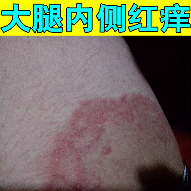 冶大腿根红斑疙瘩发痒皮肤感染干燥粗糙股专用草本软膏私处红痒