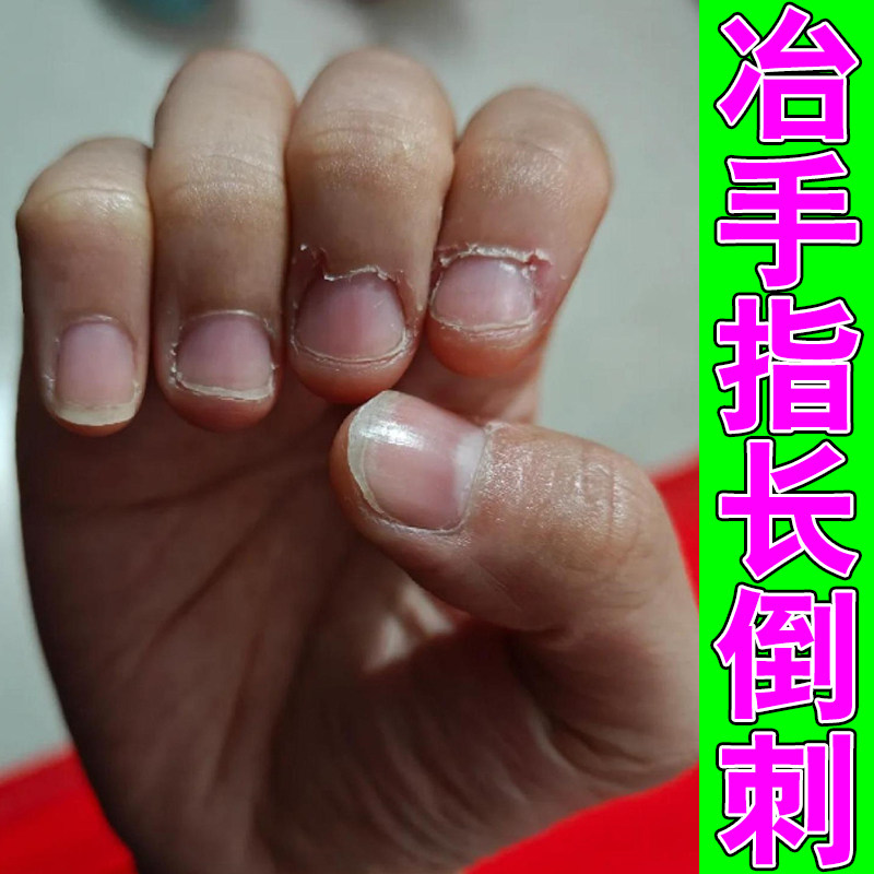 冶手指长倒刺皮肤干燥粗糙专用草本软膏手指干燥长倒刺肉刺疼痛