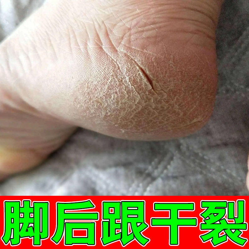 脚后跟干燥起皮屑发痒专用草本保湿软膏脚后跟干裂疼痛脱皮掉屑