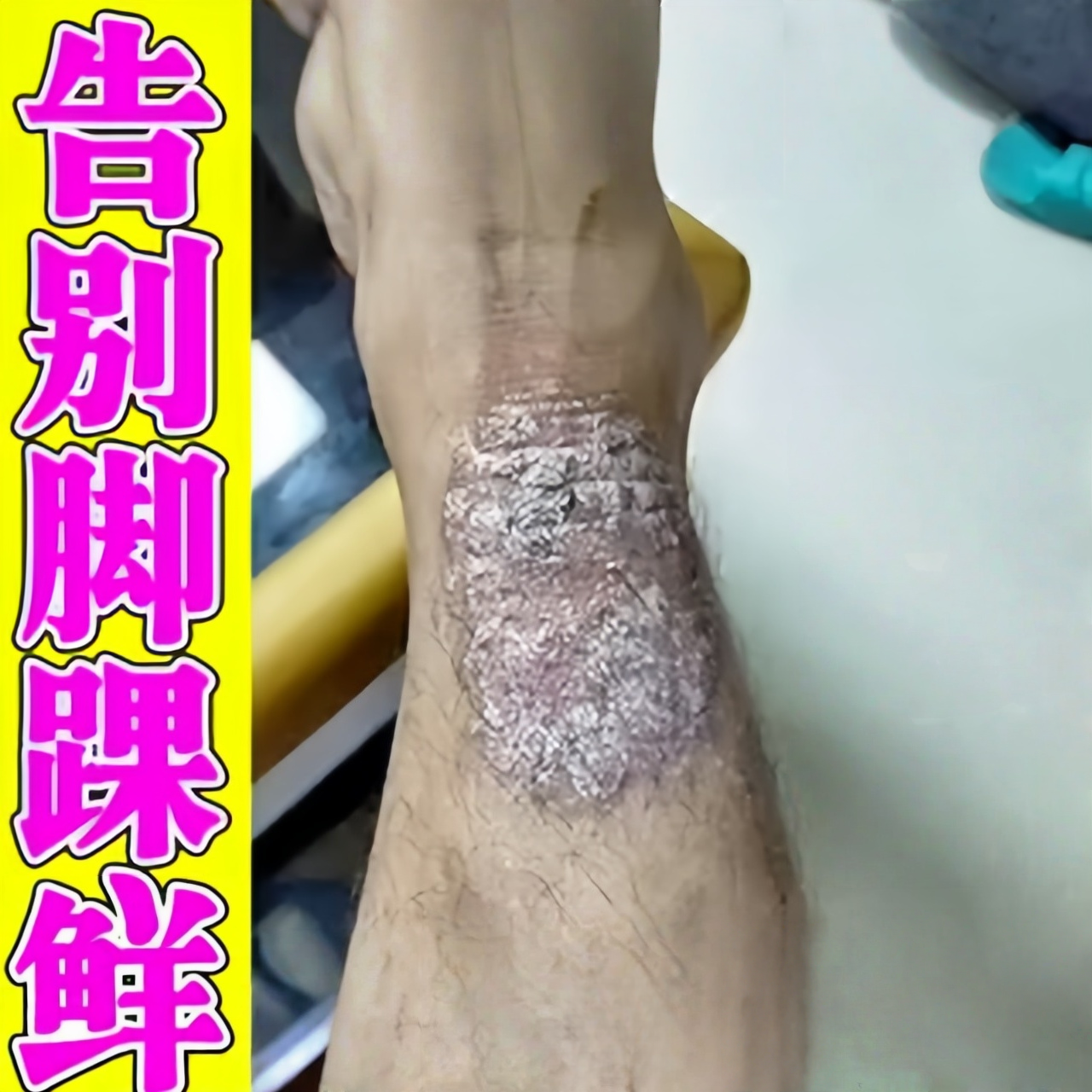 脚踝上长鲜皮肤干燥起皮痒脚脖子脚背面瘙湿痒红疹皮肤脚杆过敏药