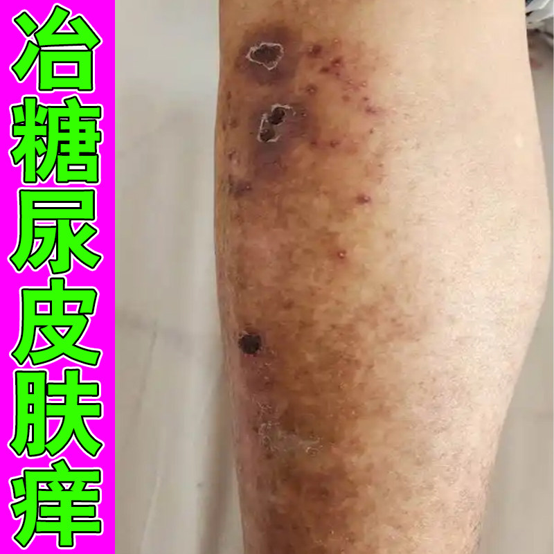 小腿皮肤干燥发痒冶糖尿皮肤痒严重草本修护软膏腿上疙瘩痒血糖高
