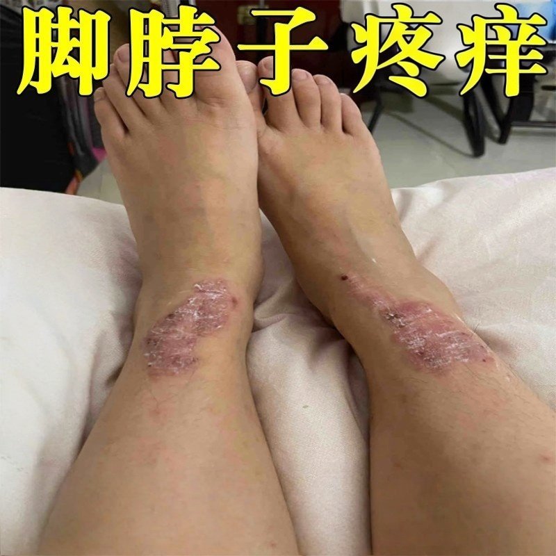 脚踝疼痒修复药小腿过敏脚脖子腿部皮肤干燥发痒越抓越痒外用乳膏