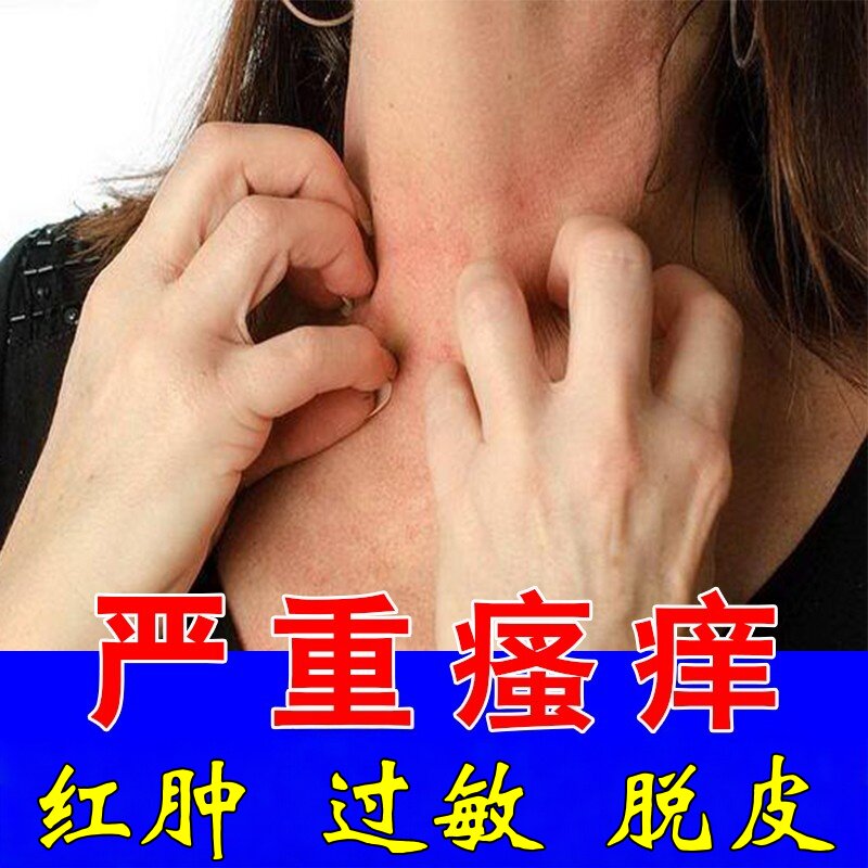 脖子过敏痒过敏性皮肤长痘痘红肿刺挠干燥痒药溢脂性皮肤炎痒止膏