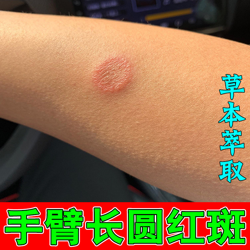 手臂长圆红斑皮肤干燥粗糙感染发痒草本修护软膏手臂长铜钱状红斑