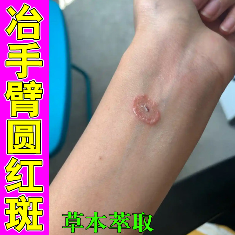 冶手臂长圆红斑皮肤干燥粗糙草本修护软膏手臂长铜钱状红斑发痒