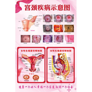 女性生殖器系统解剖宫颈疾病示意图医院妇科健康知识海报宣传画hb